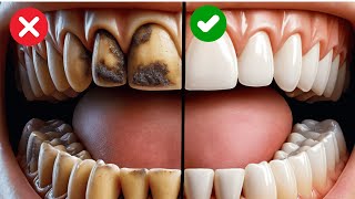 9 Natural Ways To Remove Plaque And Tartar From Your Teeth [upl. by Elaine661]