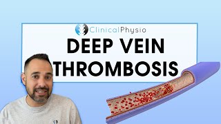 What is a DVT How do you Diagnose and Treat it  Expert Explains Everything You Need To Know [upl. by Efi]