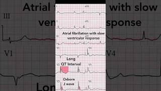 Hypothermia ECG [upl. by Nathan250]