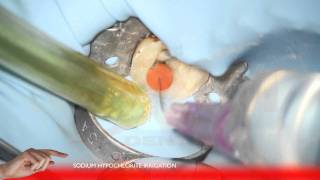 Endodontic treatment lower second molar  RECIPROC [upl. by Terencio296]