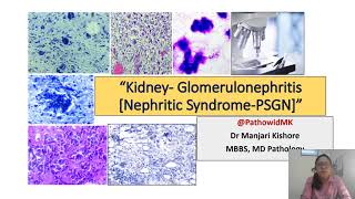 Glomerulonephritis 1 Nephritic Syndrome PSGN [upl. by Mandi945]