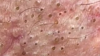 Blackheads amp Whiteheads Satisfying Removal 0057 [upl. by Nyleahcim909]