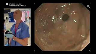 LLE 2022 Case UGI  Chronic Atrophic Gastritis and Early Gastric Cancer [upl. by Acitel842]