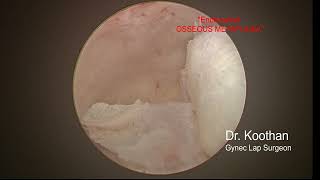 Endometrial Osseous Metaplasia [upl. by Lerud]