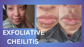 Exfoliative Cheilitis  Update [upl. by Danae]