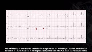 Identifying Early Signs of Acute Coronary Syndrome  Good Reads Episode 5 [upl. by Anekam584]