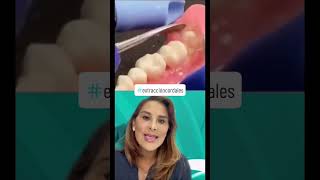 drasandranieto cordales cordales😱🦷 dientes dientesblancos extraccion odontologia parati [upl. by Lorri]