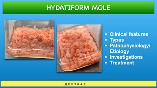 Hydatidiform Mole  Clinical features  Types  Pathophysiology  Investigations  Treatment [upl. by Areic]