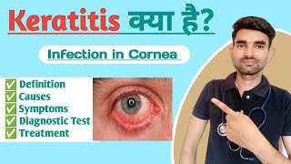 Keratitis Lecture in Hindi  Causes Symptoms and Treatment of Keratitis [upl. by Settle]