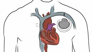 Difference Between Cardioversion and Defibrillation [upl. by Aiceila]