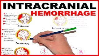 Intracranial Hemorrhage EpiduralSubduralSubarachnoid overview [upl. by Eibob186]