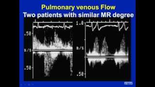 Mitral Regurgitation Revisited  Pitfalls in Severity Assessment [upl. by Yelraf]