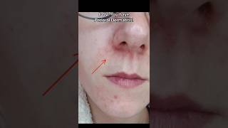 Perioral Dermatitis Demystified Understanding Treating and Preventing Flareupsviral medical [upl. by Anaitit757]