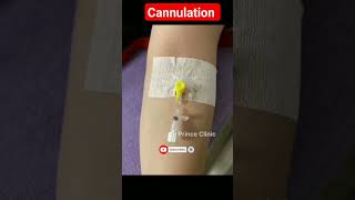 iv cannula cannula shorts injection doctordoctor cannulation viral [upl. by Ellertnom]