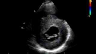 HOCM  CARDIOMYOPATHY HYPERTROPHIC echocardiography [upl. by Kit]