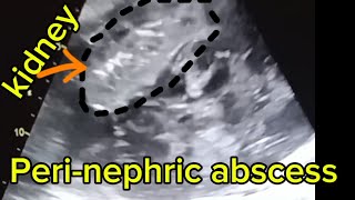 Perinephric abscess in ultrasound [upl. by Arevle428]