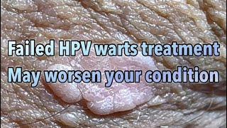 Patient comment after TCA Trichloric acid and Cryo nitrogen treatment of HPV warts made it worse [upl. by Aleece90]