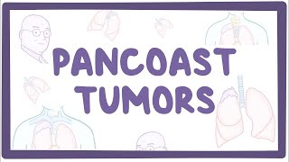 Pancoast tumors  causes symptoms diagnosis treatment pathology [upl. by Dlabihcra337]