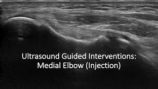 Ulrasound Guided Interventions Medial Elbow Injection ultrasound [upl. by Sadnac517]