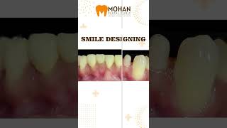 Digital Smile Designing Treatment Hyderabad  Before amp After  mohandentalclinic smiledentist [upl. by Alleirbag404]