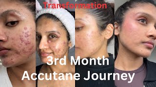 3Month Accutane Update My Skin Progress So Far [upl. by Ardnaxela]