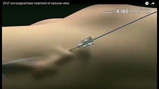 EVLT Laser Treatment for Varicose Veins The Future of Varicose Vein Treatment Animation Video [upl. by Klos]