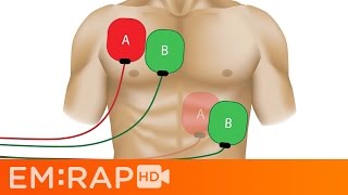 Double Sequential Defibrillation [upl. by Lamont]