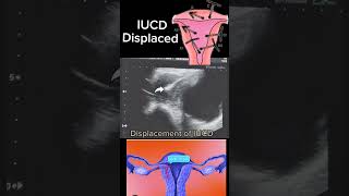 Displaced IUCD Causes Diagnosis and Management shortsbeta yt healthytips DrSaimakhan [upl. by Eardnoed]