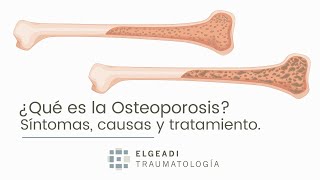 Qué es la osteoporosis síntomas causas y tratamiento [upl. by Cerracchio]