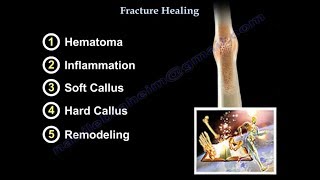 Fracture Healing  Everything You Need To Know  Dr Nabil Ebraheim [upl. by Eelnyl]