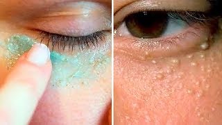 How To Get Rid of Milia at Home  Safe Easy amp Scar Free [upl. by Morena]