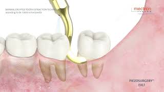 PIEZOSURGERY  Dr Fabrizio Fontanella  Normal erupted tooth extraction technique [upl. by Oira486]