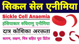 सिकल सेल एनीमिया  sickle cell anemia in hindi  sickle cell anemia class 12 biology ScienceSK [upl. by Yulma929]