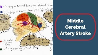 Middle Cerebral Artery Stroke [upl. by Salbu343]