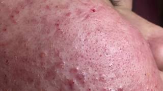 Mai 12 Inflammatory acne treatment for Mai part 1 section 2  30122019 [upl. by Supen7]