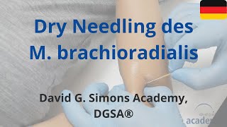 Dry Needling des M brachioradialis [upl. by Duaner]