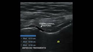 Regeneração de Cartilagem em Joelho  Método TIRT Terapia Indutora de Regeneração Tecidual [upl. by Halueb]