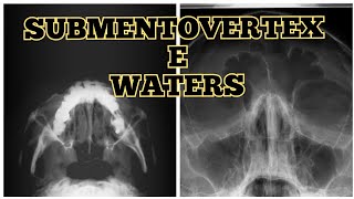 POSICIONAMENTOS DE WATERS E SUBMENTOVERTEX [upl. by Notnyw]