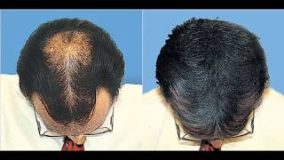 Hair Loss How To Regrow Hair Naturally Before and After Photos [upl. by Odnomra]