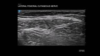 Thigh Ultrasound Lateral Femoral Cutaneous Nerve LFCN Block for Meralgia Parasthetica [upl. by Eanwahs406]