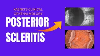 Posterior scleritisKanskis clinical ophthalmology sclera ophthalmology medical kanski [upl. by Shirah]