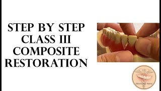 STEP BY STEP  Class III composite restoration [upl. by Valli]