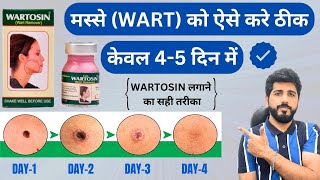 WARTOSIN  MASSE WART KO AISE HATAYE  WARTOSIN USE KARNE KA SAHI TREEKA  WART REMOVER [upl. by Ttereve]