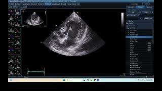 IQ 279 HEMODYNAMIC ECHOPAC ANALYSIS ECHOCARDIOGRAPHY HEPATOMA [upl. by Heilman]