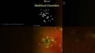 Multifocal Choroiditis Symptoms and Treatment ophthalmology optometry [upl. by Ecnatsnok]