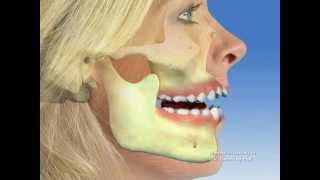 TMJ  Temporomandibular joint dysfunction [upl. by Narad]