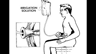 How to Irrigate Your Colostomy [upl. by Philan]