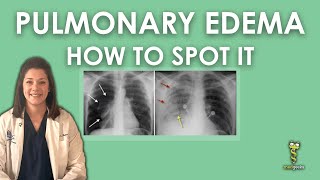 Pulmonary Edema Chest Xray [upl. by Marcelline]