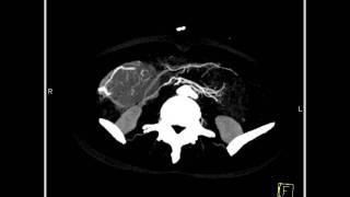 Abdomen Liver Focal Nodular Hyperplasia A series of images and coronal3 of 5 [upl. by Zsa Zsa149]