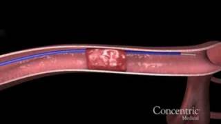 MERCI clot retreival catheter for ischemic stroke [upl. by Lardner]